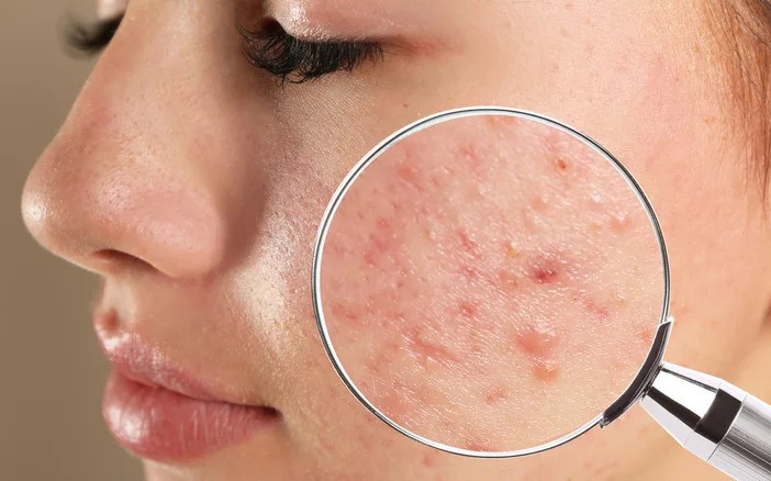 رازهای آرایش صورت بدون جوش-جوش آرایشی