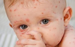 شیوع «آبله مرغان» در بهار