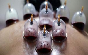 حجامت توسط افراد غیر متخصص خطرناک است