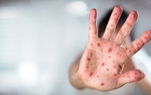 موج سرخک در بنگلادش جان ۵۰۰ کودک را گرفت